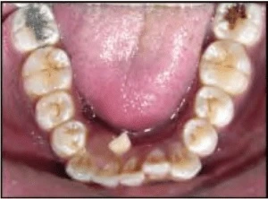 NHỔ RĂNG CỬA TRƯỚC HÀM DƯỚI