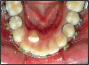 PHƯƠNG PHÁP TẠO KHOẢNG TRONG CHỈNH NHA PHẦN CUỐI NHỔ RĂNG DƯỚI HÀM DƯỚI