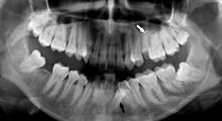 HÀM TRÊN BỊ SÂU RĂNG NGHIÊM TRỌNG