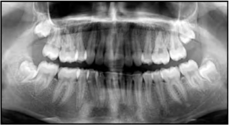 RĂNG CỐI NHỎ NHẤT HÀM