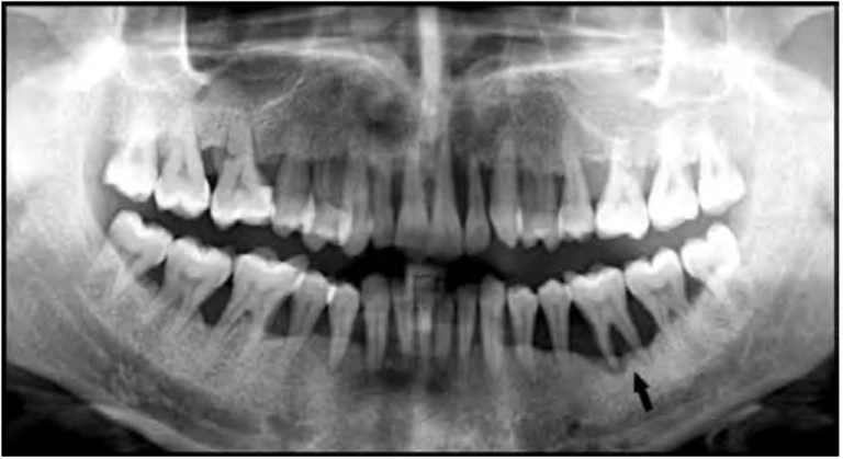 PHƯƠNG PHÁP TẠO KHOẢNG TRONG CHỈNH NHA PHẦN CUỐI NHỔ VÌ TÌNH TRẠNG NHA CHU