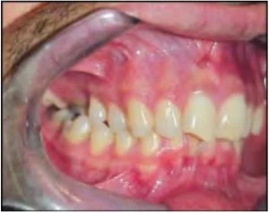 RĂNG TRÊN BỊ SÂU NGHIÊM TRỌNG