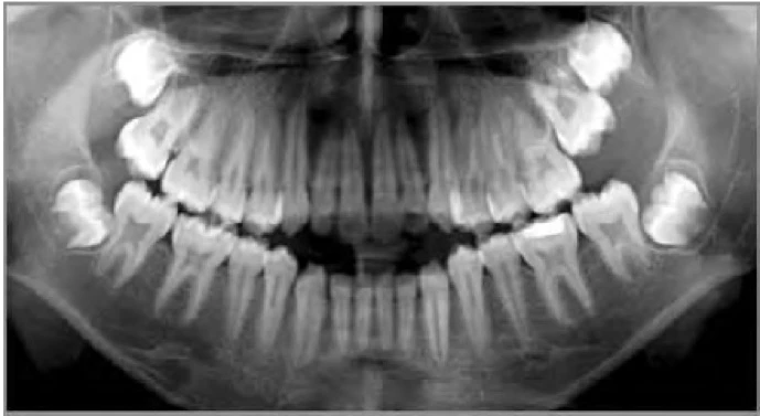 PHƯƠNG PHÁP TẠO KHOẢNG TRONG CHỈNH NHA PHẦN CUỐI NHỔ RĂNG CỐI THỨ HAI