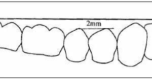 su-dich-chuyen-rang-trong-chinh-nha