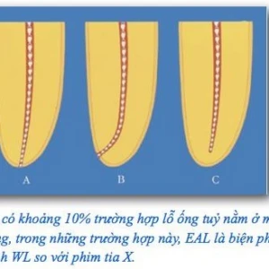 Máy định vị chóp (electronic apex locators EAL) phần 1 - 10 file