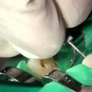 Các phương pháp xác định chiều dài làm việc trong điều trị nội nha (p2) - 14 file