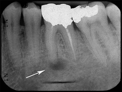 rang-da-duoc-dieu-tri-truoc-day