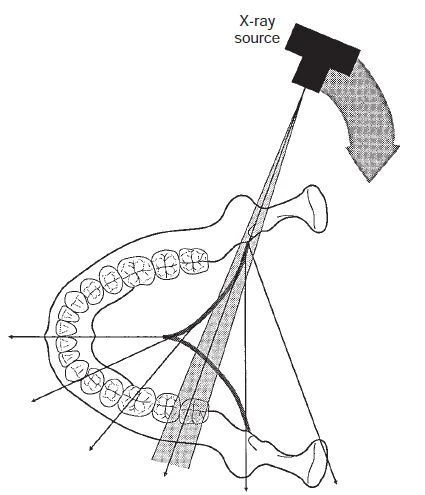 Hình 5. Di chuyển của nguồn và chùm tia X. Đường kẽ đen biểu thị sự di chuyển liên tục của tâm xoay. Vì nguồn di chuyển sau cổ bệnh nhân và chụp lại các răng trước, tâm xoay di chuyển ra trước dọc theo vòng cung (đường đen) hướng về mặt phẳng dọc giữa. Nguồn tia X tiếp tục di chuyển xung quanh bệnh nhân để chụp ảnh bên phía đối diện.