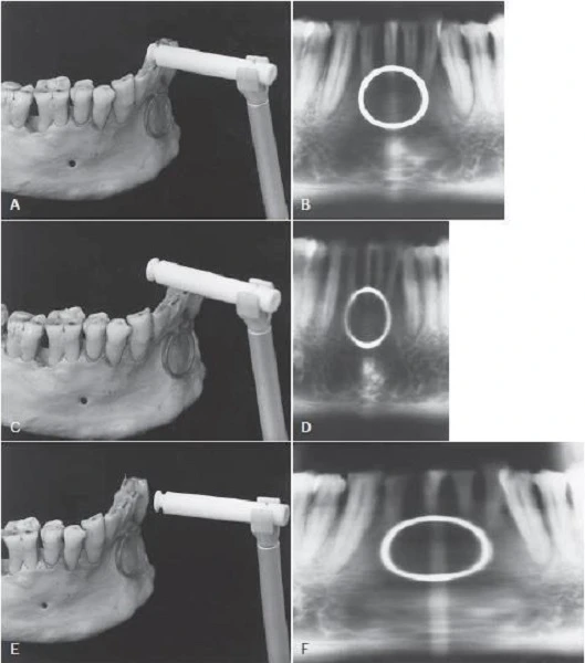 Hình 7. A, Xương hàm dưới có gắn một vòng kim loại nằm ngay giữa máng tiêu cự. Rìa cắn của răng cửa hàm dưới được định vị bởi thanh cắn. Xương hàm dưới nằm giữa ống chụp. B, Kết quả phim toàn cảnh. C, Xương hàm dưới và vòng kim loại nằm về phía trước 5mm so với máng tiêu cự. Rìa cắn răng cửa nằm phía trước máng. D, Kết quả phim toàn cảnh cho thấy sự giảm kích thước chiều ngang của cả vòng và răng hàm dưới. E, Xương hàm dưới và vòng nằm về phía sau so với máng tiêu cự 5 mm. Rùa cắn răng cửa nằm phía sau máng. F, Kết quả phim x-quang toàn cảnh cho thấy tăng kích thước chiều ngang của cả vòng và răng của hàm dưới.