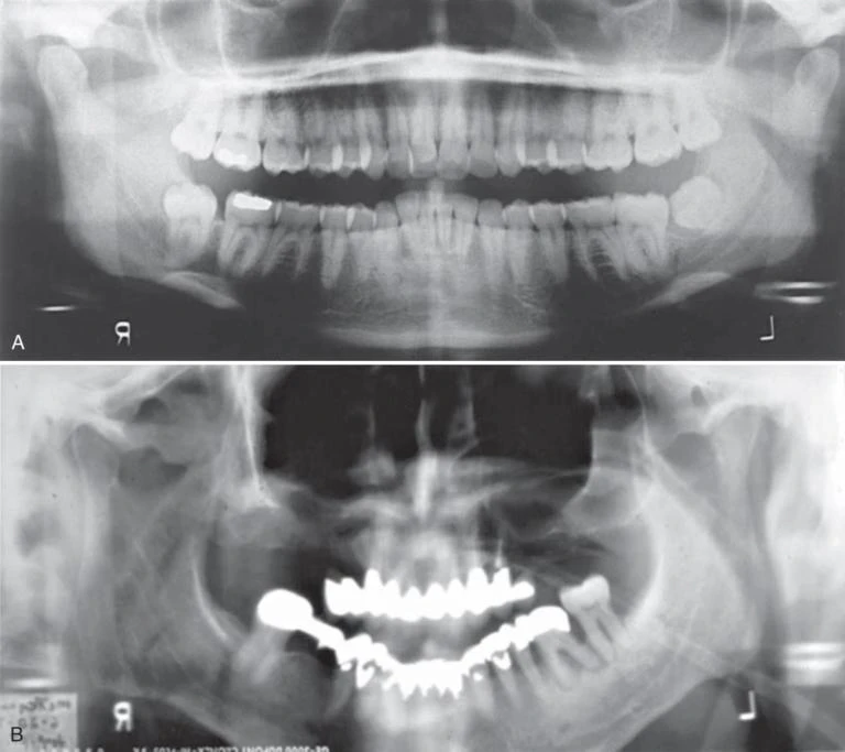 Hình 12. Phim toàn cảnh cho thấy đầu bệnh nhân ở tư thế sai. A, Cằm và mặt phẳng nhai bị xoay lên trên, dẫn đến hình ảnh các răng chồng lên nhau và bóng mờ (khẩu cái cứng) che khuất chân các răng hàm trên. B, Cằm và mặt phẳng nhai bị xoay xuống dưới, thiếu mất vùng cằm trên phim X quang và biến dạng các răng trước.