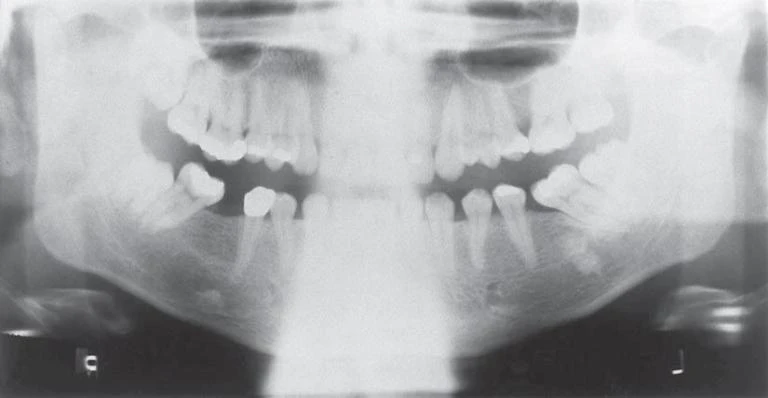 Hình 13. Phim toàn cảnh của một bệnh nhân có vị trí sai. Lưu ý vùng thấu quan lớn ở giữa. Hình ảnh này (“hình ảnh ma bóng cột sống”) có thể được loại bỏ bằng cách yêu cầu bệnh nhân ngồi thẳng và ngay ngắn hoặc giữ thẳng cổ.