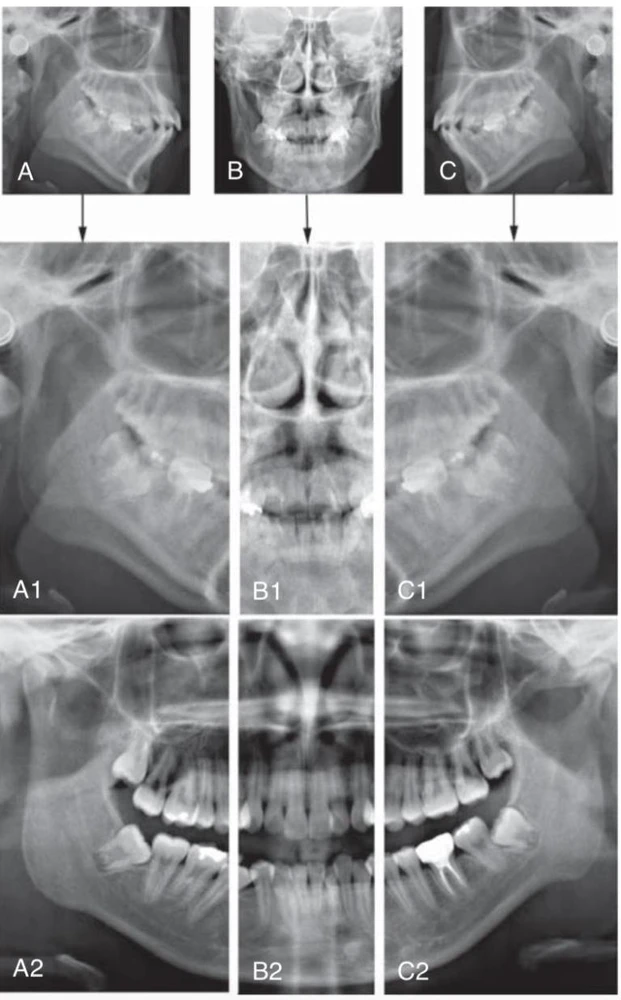 Hình 15. Phân tích phim toàn cảnh theo từng phần. Hình ảnh phim toàn cảnh bao gồm phần bên phải và bên trái liên kết với phần ở giữa bởi một hình theo chiều trước sau; nó tương tự với phép chiếu Mercator của quả địa cầu. Điều này được đánh giá bằng cách so sánh hình ảnh phim toàn cảnh phân đoạn với những cấu trúc trên phim cephalometric chụp trên cùng bệnh nhân. A-C, Hình ảnh cephalometric bên trái, trước sau, và bên phải. Những hình ảnh này được cắt và sắp xếp như hình A1-C1. A2-C2 là hình ảnh phân đoạn của phim toàn cảnh trên cùng bệnh nhân. Lưu ý những điểm tương tự giữa hình ảnh cephalometrics phía bên và hình ảnh trên phim toàn cảnh phía sau răng nanh, và giữa hình ảnh phim cephalometrics theo chiều trước sau và hình ảnh phim toàn cảnh giữa các răng nanh. Vì vậy, khi phân tích phim toàn cảnh, nhà lâm sàng nên nghĩ đến việc quan sát các hình chiếu bên phải, bên trái và hình chiếu giữa mặt và kết nối chúng với nhau.