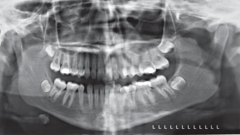 Hình 8. Hình ảnh phim toàn cảnh cho thấy xoay mặt phẳng dọc giữa sai. Đầu bệnh nhân bị xoay sang trái, khiến phần bên phải gần với receptor hơn và bên trái xa receptor hơn. Lưu ý độ phóng đại tương đối của răng cối lớn, cành đứng xương hàm dưới, và lồi cầu phía bên trái và các răng phía sau chồng lên nhau nhiều. Điều quan trọng là nhận ra sự biến dạng thường gặp này và không nhầm lẫn điều này với bất cân xứng xương.