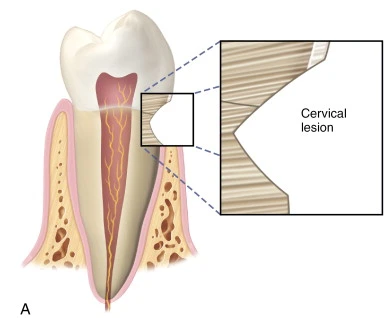 ky-thuat-dan-nga-voi-keo-dan-mot-thanh-phan