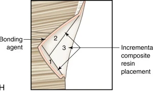Kỹ thuật dán ngà với keo dán một thành phần: hướng dẫn lâm sàng - 34 file