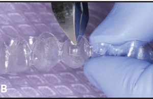 Kĩ thuật gắn attachment invisalign cải tiến - 35 file