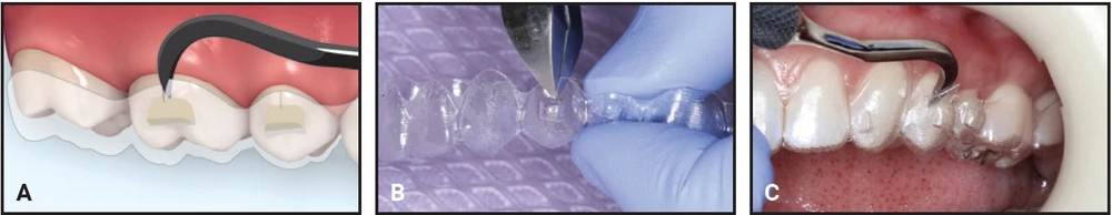 kỹ thuật gắn attachment