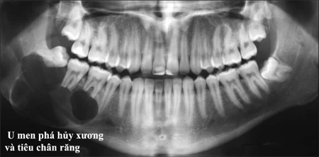 U men răng