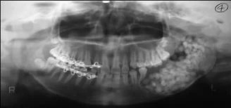 Các loại u lành tính do răng phần 1 : u men - 21 file