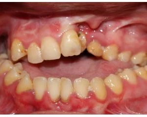 Dị tật bẩm sinh hàm mặt - 11 file