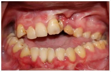 Dị tật bẩm sinh hàm mặt