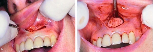 Đường rạch mở vạt bán nguyệt, bóc tách vạt toàn phần bộc lộ xương vùng chóp răng tương ứng