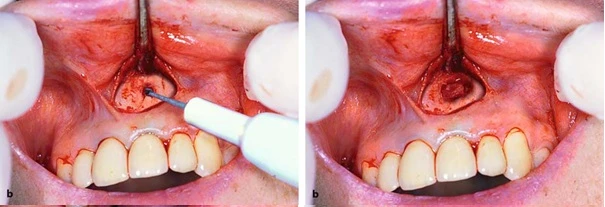 Tay khoan thẳng với mũi tròn có rãnh xoắn lớn mở cửa sổ xương tiếp cận vùng chóp