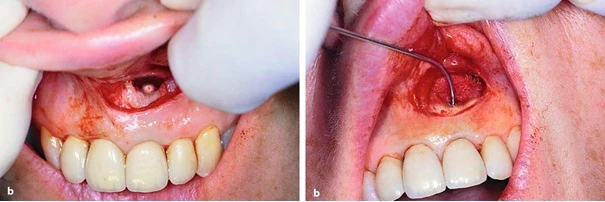 Xoang trám đã được tạo xong, cần nhồi vật liệu trám vào