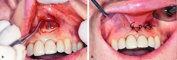 Nhồi chặt chất trám và khâu đóng vết mổ