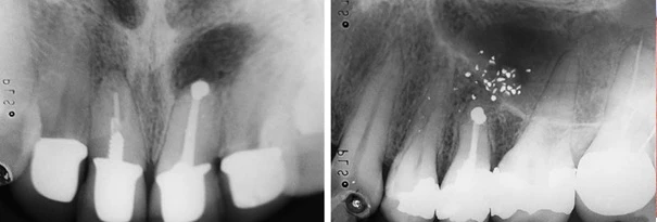 So sánh một ca cắt chóp trám ngược tốt với chất trám bít kín chóp răng và một trường hợp để rơi chất trám ra mô quanh chóp