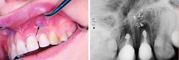 Nhiễm sắc niêm mạc quanh chóp răng tương ứng do rơi vãi almagam ra mô mềm quanh chóp
