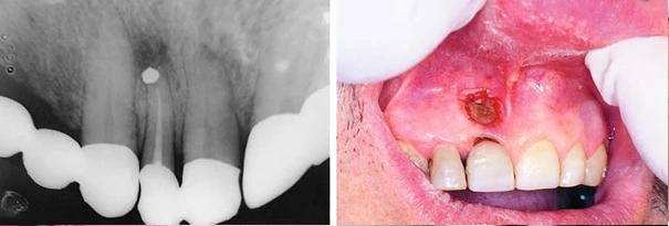 Phim X quang mô tả xoang trám không được chuẩn bị tốt chất trám ngược bị bong