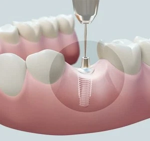 Quy trình phẫu thuật dịch chuyển dây thần kinh răng dưới để cấy ghép Implant - 141 file