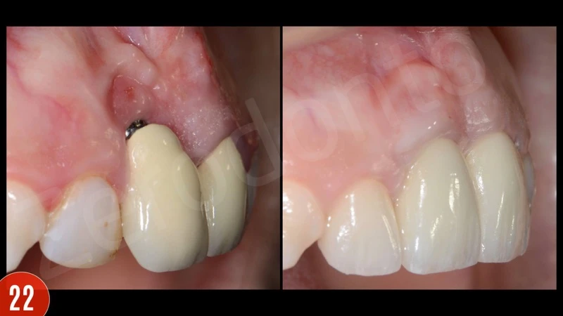 Phẫu thuật tái tạo quanh răng-phẫu thuật quanh Implant: sửa chữa các lỗi điều trị - 168 file