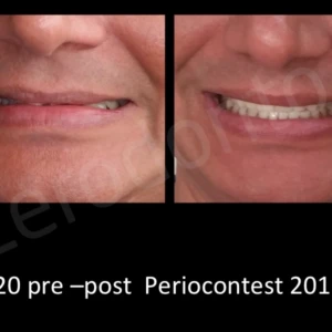 Quản lý papilla liên tục với tái tạo hướng tái tạo - 189 file