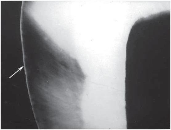 Phim cận chóp ban đầu