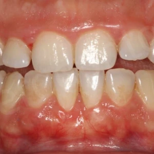 Kĩ thuật tunnel technique điều trị tụt lợi - 207 file