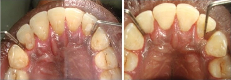 Rãnh chân răng vòm miệng: kẻ giết “răng” thầm lặng - 226 file