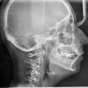 Phân tích Cephalometric (phần 1) - 23 file