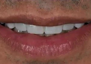 Quy trình thiết kế nụ cười kỹ thuật số Digital Smile design - 276 file