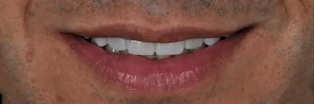 Quy trình thiết kế nụ cười kỹ thuật số Digital Smile design - 276 file