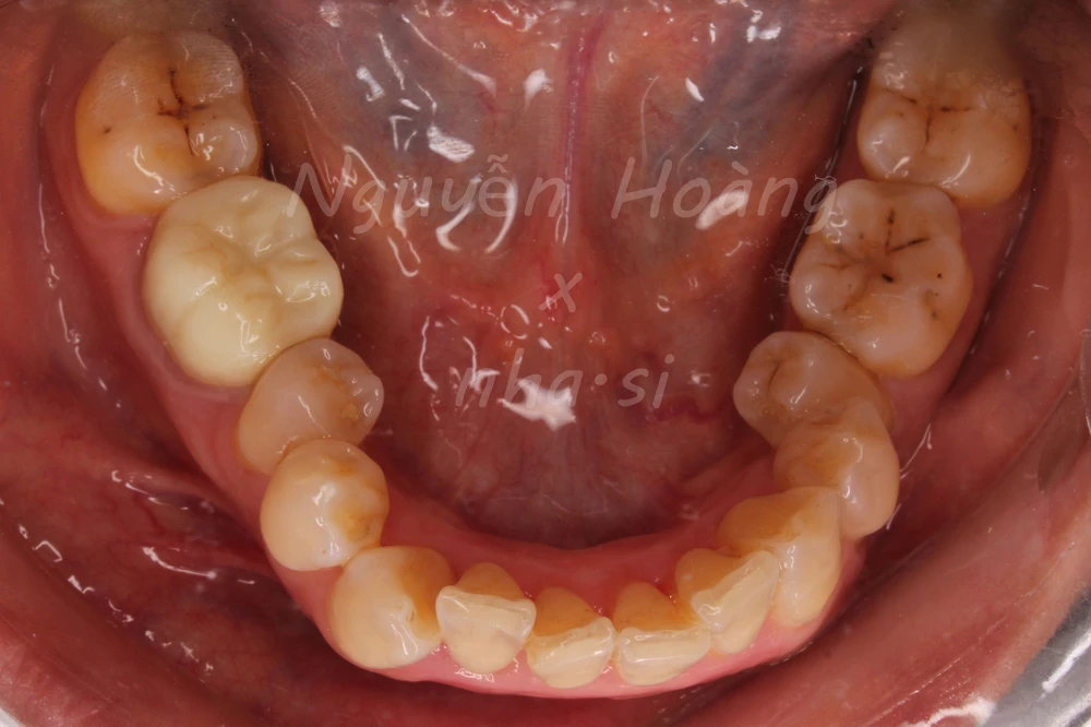 Dựng trục răng hàm nhỏ trong phục hình răng sứ thẩm mỹ