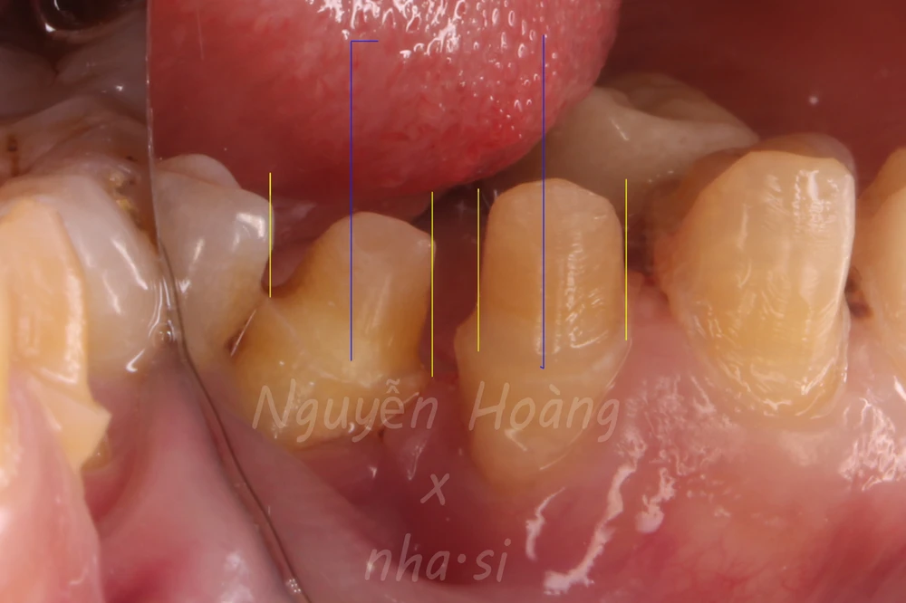 Dựng trục răng hàm nhỏ trong phục hình răng sứ thẩm mỹ