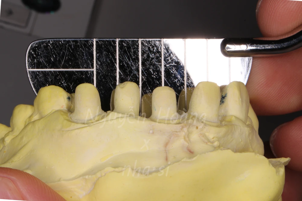 Dựng trục răng hàm nhỏ trong phục hình răng sứ thẩm mỹ