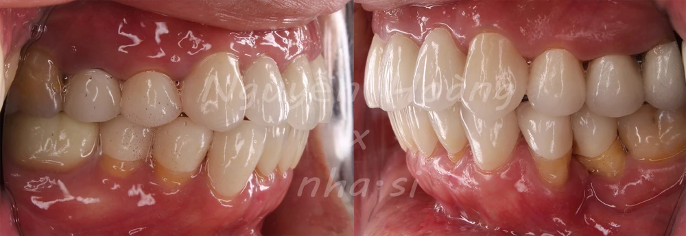 Dựng trục răng hàm nhỏ trong phục hình răng sứ thẩm mỹ