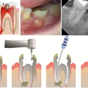 Xử lý khẩn cấp nội nha (phần 3) - 37 file