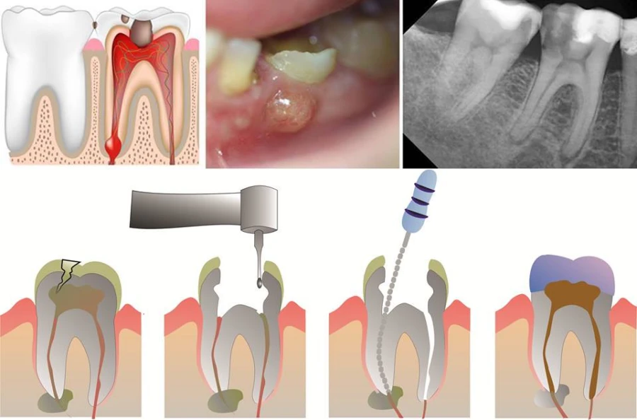 Xử lý khẩn cấp nội nha (phần 3) - 37 file