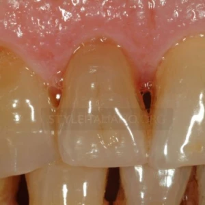 Xử lý tình huống gãy ngang chân răng - điều trị - 72 file