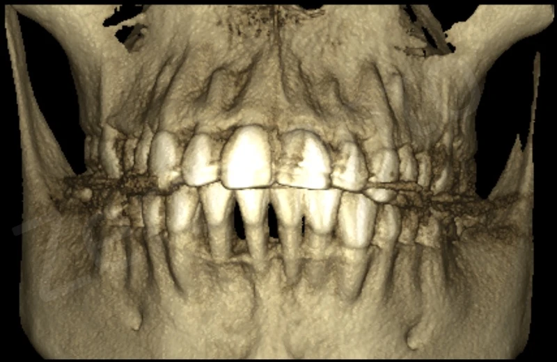 Kỹ thuật ghép ngầm 3D mô mềm