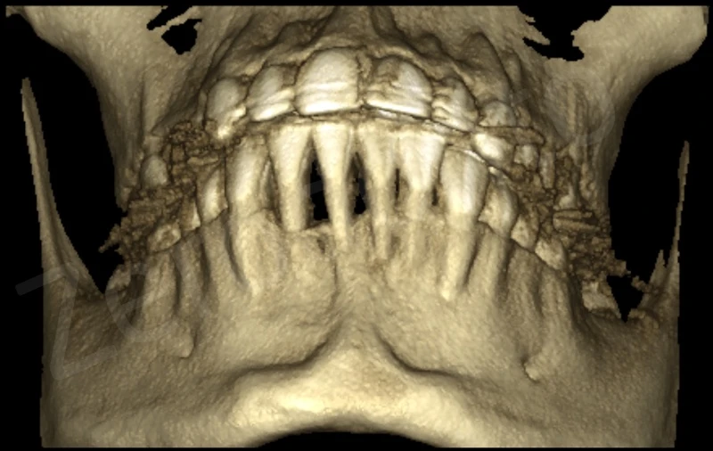 Kỹ thuật ghép ngầm 3D mô mềm
